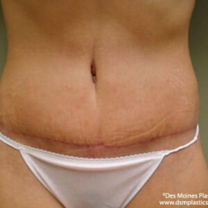 Tummy Tuck before and after photos