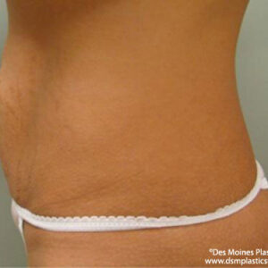 Tummy Tuck before and after photos