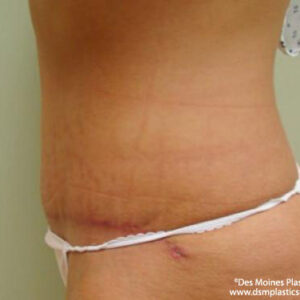Tummy Tuck before and after photos