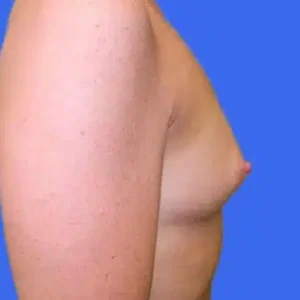 Breast Augmentation before and after photos Breast Augmentation before and after photos