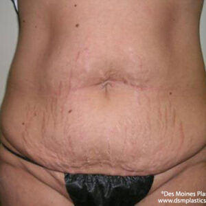 Tummy Tuck before and after photos