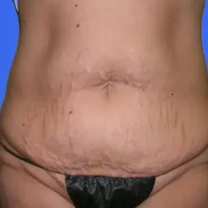 Tummy Tuck before and after photos Tummy Tuck before and after photos