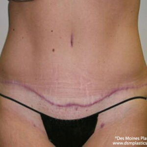 Tummy Tuck before and after photos
