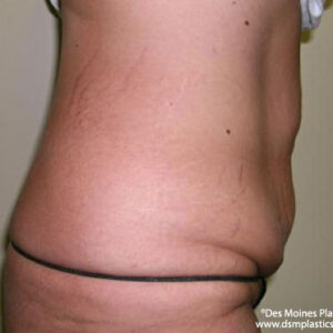 Tummy Tuck before and after photos