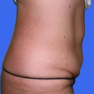 Tummy Tuck before and after photos Tummy Tuck before and after photos