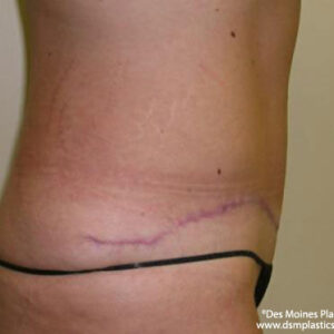 Tummy Tuck before and after photos
