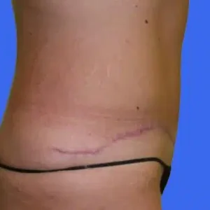 Tummy Tuck before and after photos Tummy Tuck before and after photos