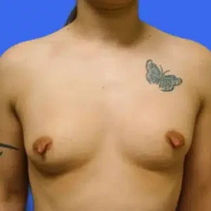 Breast Augmentation before and after photos Breast Augmentation before and after photos