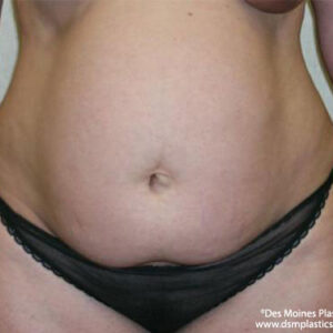 Tummy Tuck before and after photos