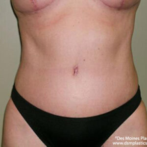Tummy Tuck before and after photos