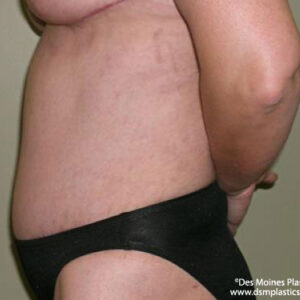Tummy Tuck before and after photos
