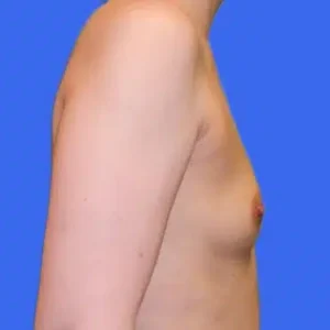 Breast Augmentation before and after photos Breast Augmentation before and after photos