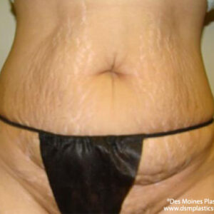 Tummy Tuck before and after photos