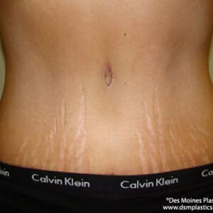Tummy Tuck before and after photos
