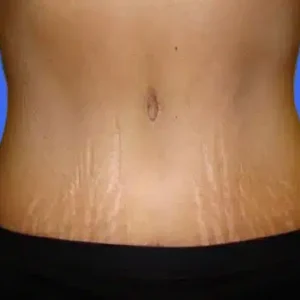 Tummy Tuck before and after photos Tummy Tuck before and after photos