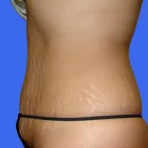 Tummy Tuck before and after photos Tummy Tuck before and after photos