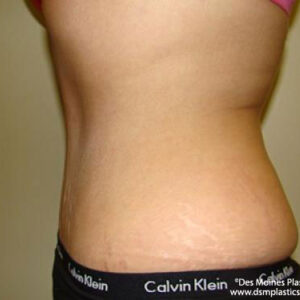 Tummy Tuck before and after photos
