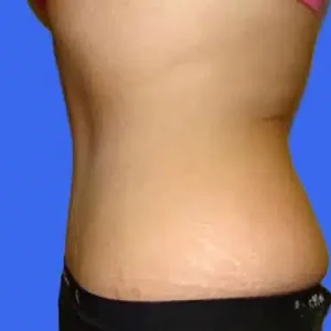 Tummy Tuck before and after photos Tummy Tuck before and after photos