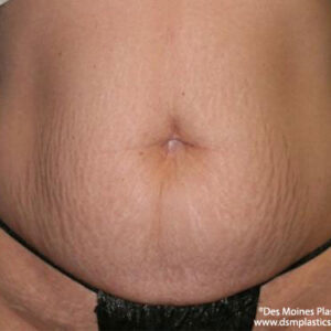 Tummy Tuck before and after photos