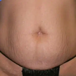 Tummy Tuck before and after photos Tummy Tuck before and after photos