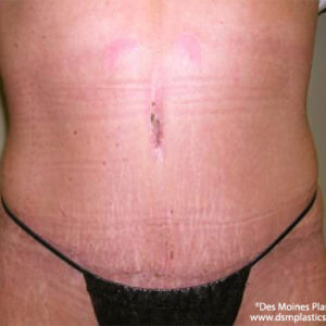 Tummy Tuck before and after photos