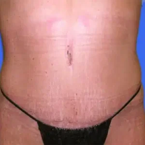 Tummy Tuck before and after photos Tummy Tuck before and after photos