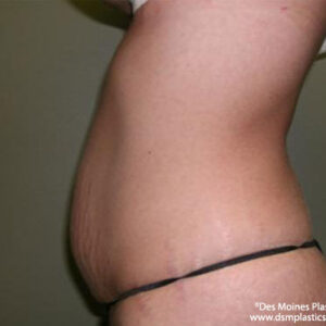 Tummy Tuck before and after photos