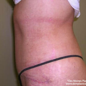 Tummy Tuck before and after photos