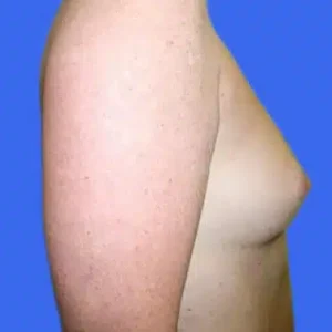 Breast Augmentation before and after photos Breast Augmentation before and after photos