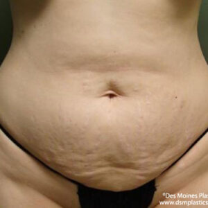 Tummy Tuck before and after photos