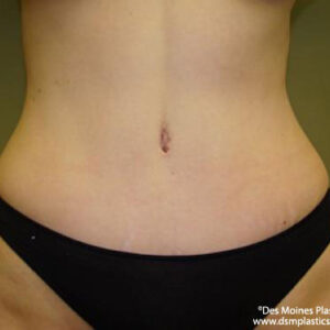 Tummy Tuck before and after photos
