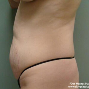 Tummy Tuck before and after photos
