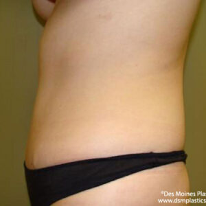 Tummy Tuck before and after photos