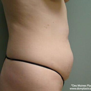 Tummy Tuck before and after photos