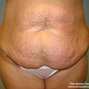 Tummy Tuck before and after photos