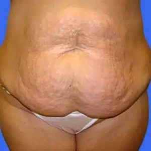 Tummy Tuck before and after photos Tummy Tuck before and after photos