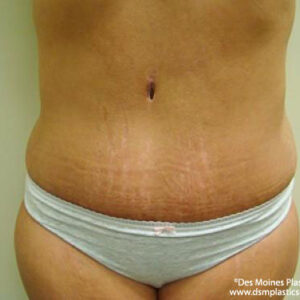Tummy Tuck before and after photos