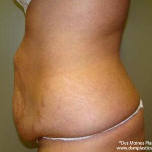 Tummy Tuck before and after photos