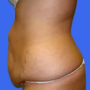 Tummy Tuck before and after photos Tummy Tuck before and after photos