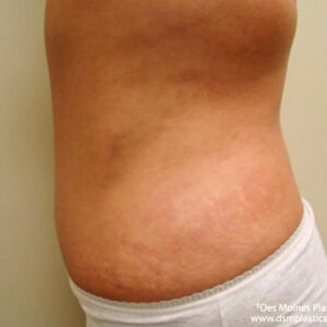 Tummy Tuck before and after photos