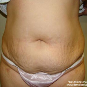 Tummy Tuck before and after photos