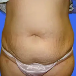 Tummy Tuck before and after photos Tummy Tuck before and after photos