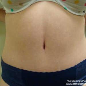 Tummy Tuck before and after photos
