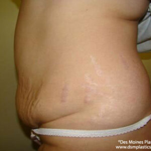 Tummy Tuck before and after photos