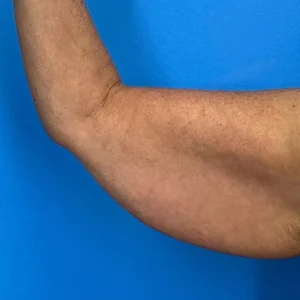 arm Lift