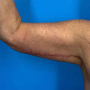 arm Lift