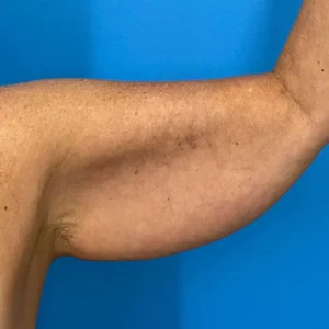 arm Lift