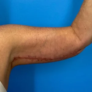 arm Lift
