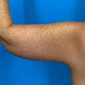 arm Lift