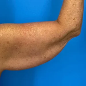 arm Lift